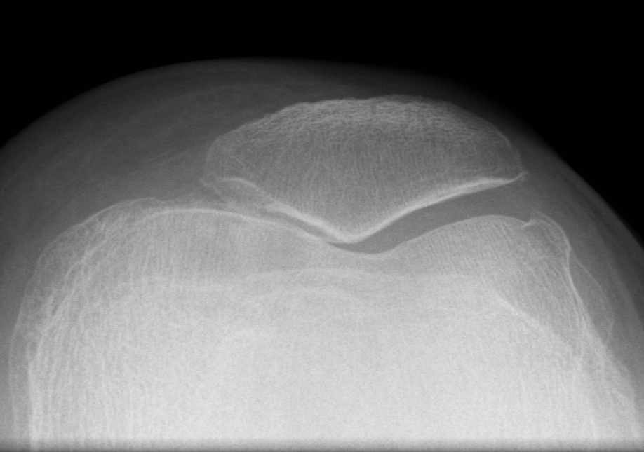 Patella OA Medial Facet